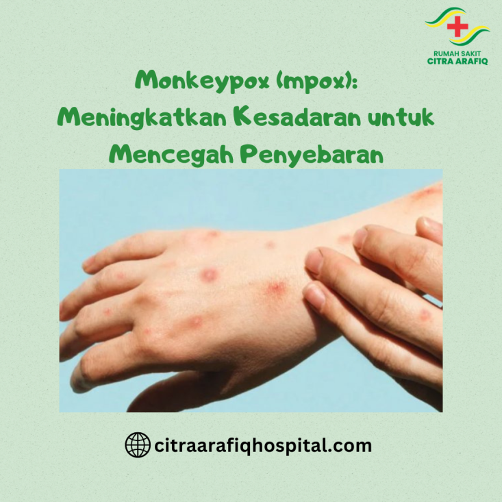 Monkeypox (mpox): Meningkatkan Kesadaran untuk Mencegah Penyebaran