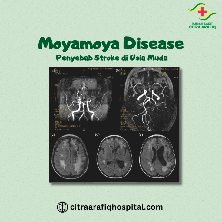 Moyamoya Disease: Penyebab Stroke di Usia Muda